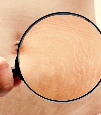 procedimentos-esteticos-estrias-dr-tovo-clinica-tovo-dermatologia