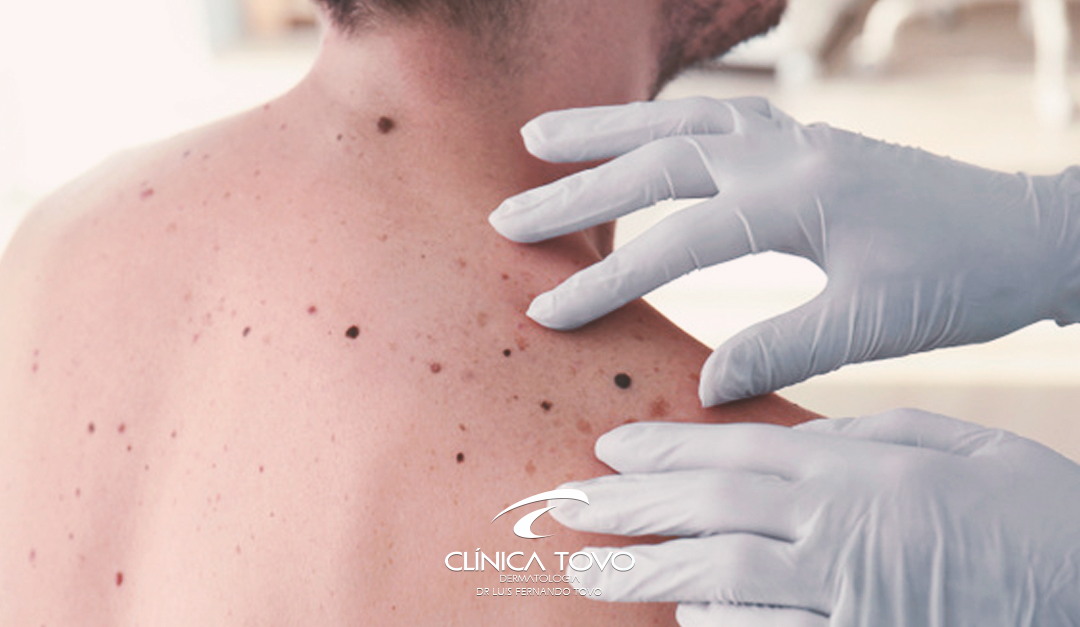 Informações sobre o Melanoma