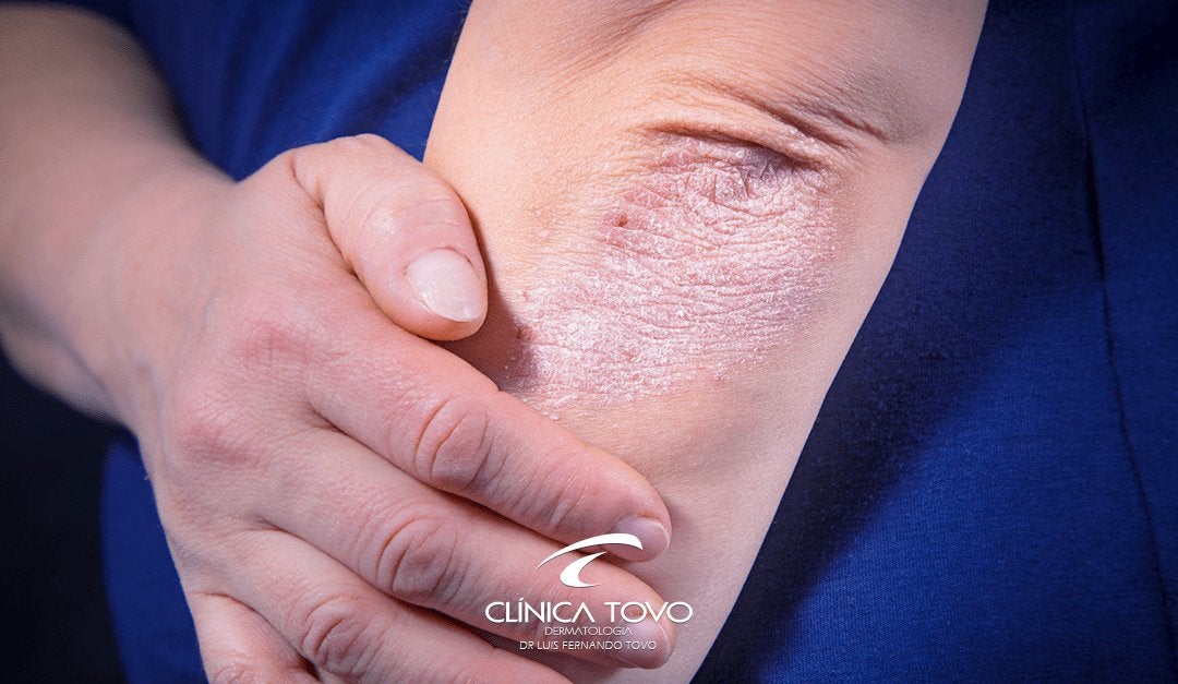 Tratamento de Dermatite Atópica com Dupilumab – Um Recente Avanço na Dermatologia