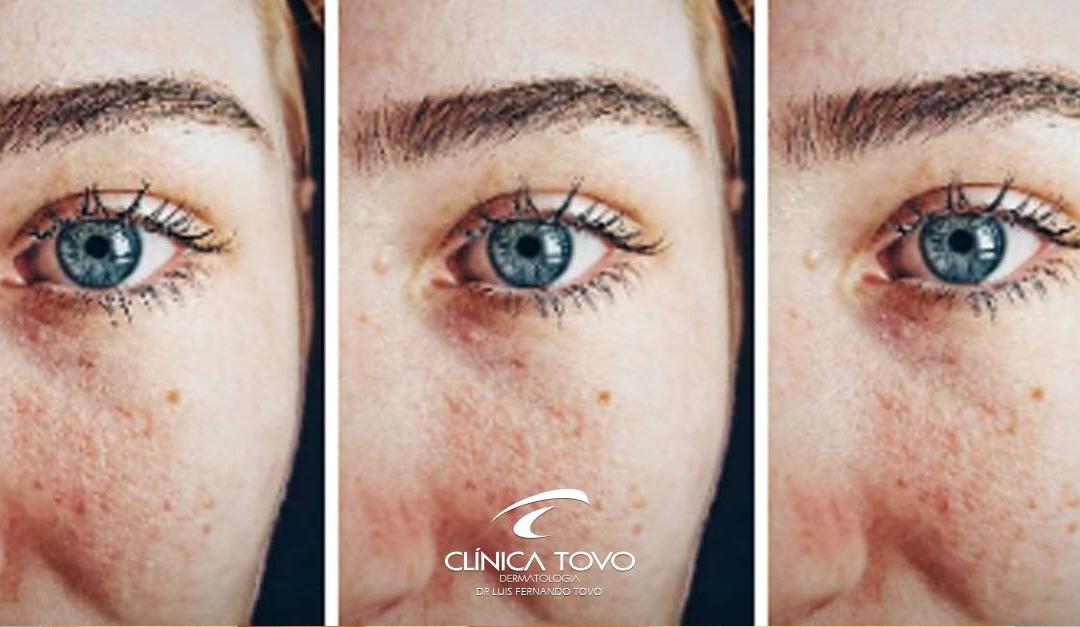 Dermatologia na Adolescência – Dr Tovo Luis Fernando Tovo clinica tovo dermatologia