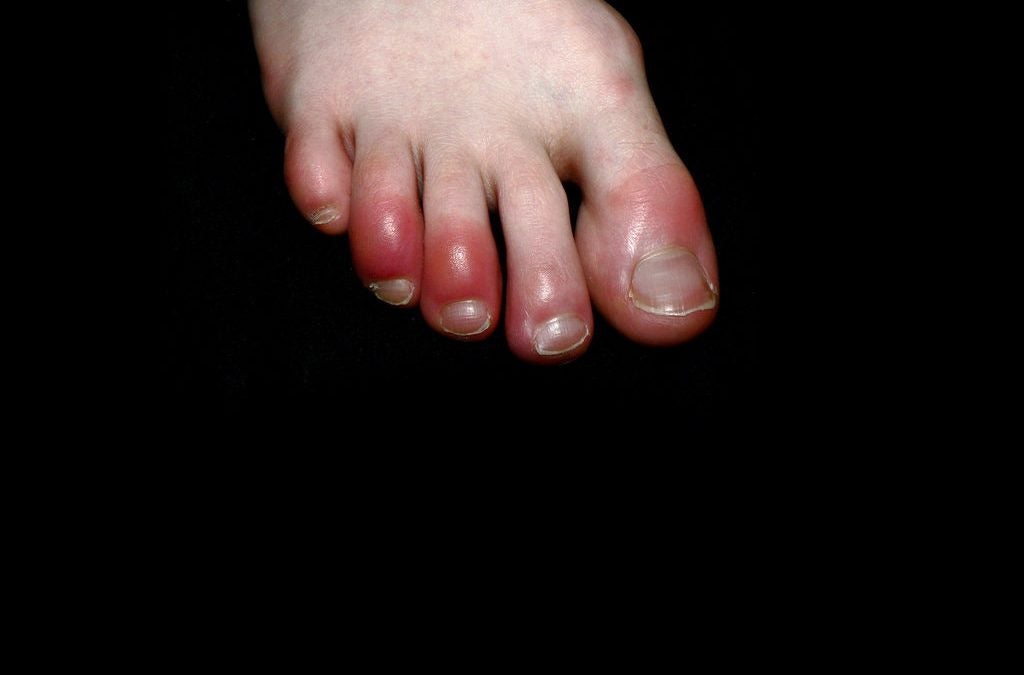 LESÕES DERMATOLÓGICAS NO COVID-19. O que é o dedo Covid (Covid Toe)?