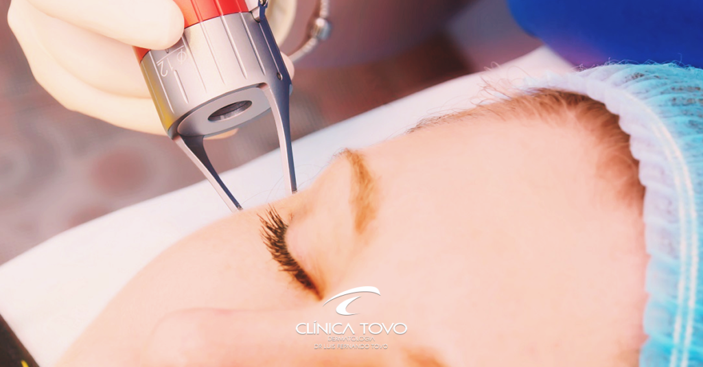 Laser Fracionado Funciona para Marcas de Acne e Cicatrizes?